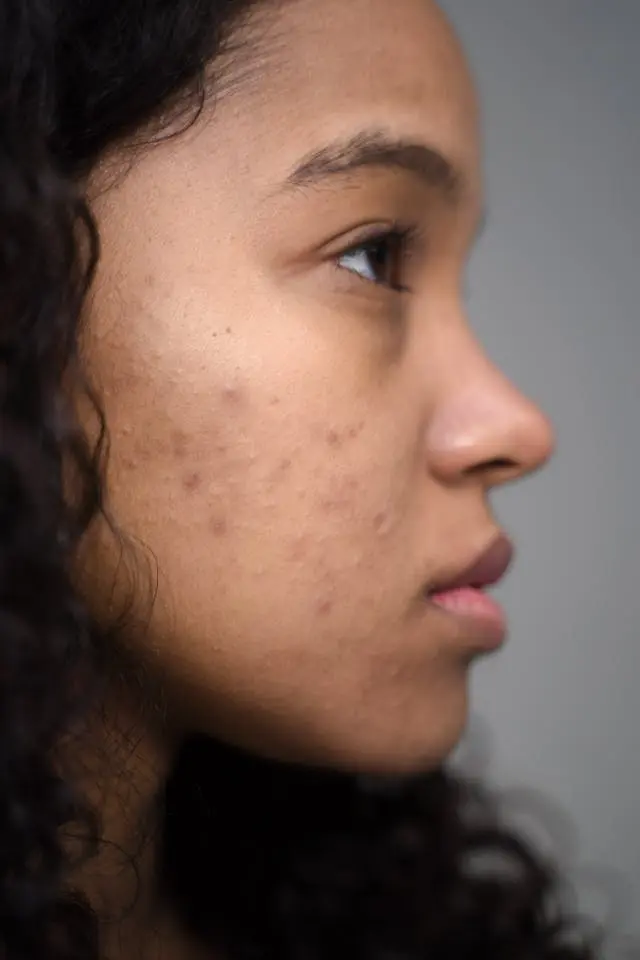 Visage jeune fille noire de profil avec acné sure la joue
