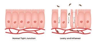 C:\Users\Tsiory\Desktop\My work\Rédaction\Malt\jean MALT\201905\10\leaky gut\images.jpg